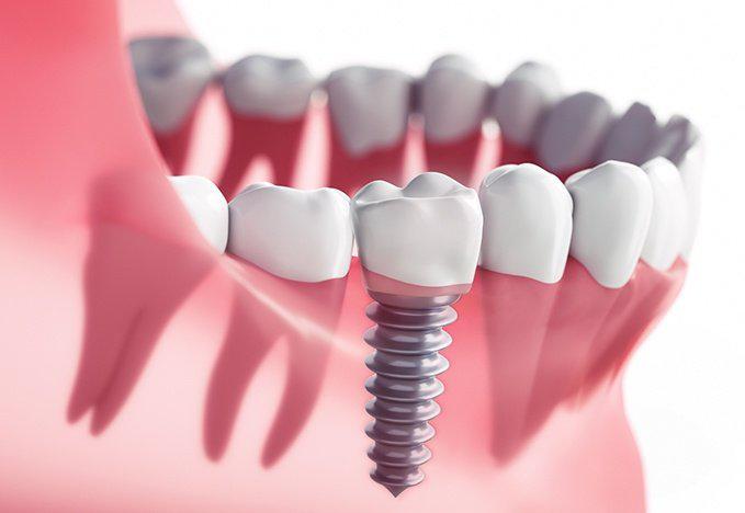 Dental Implants Alliance Ohio: Albrecht Dental