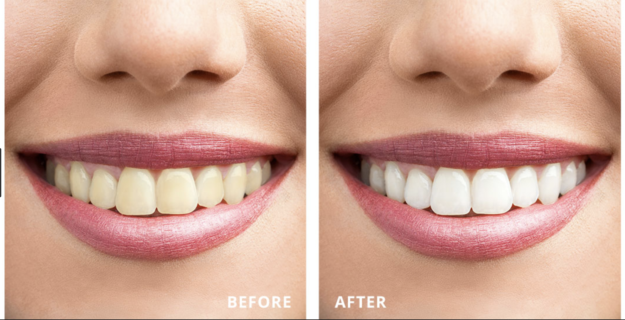 Alliance Ohio Teeth Whitening: Albrecht Dental